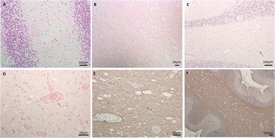 Activated microglia and neuroinflammation as a pathogenic mechanism in Leigh syndrome